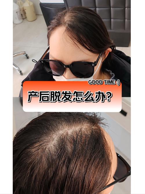 孕期脱发后，头发真的能重新长出来吗？需要多久才能恢复呢？-第1张图片-郑州医学网