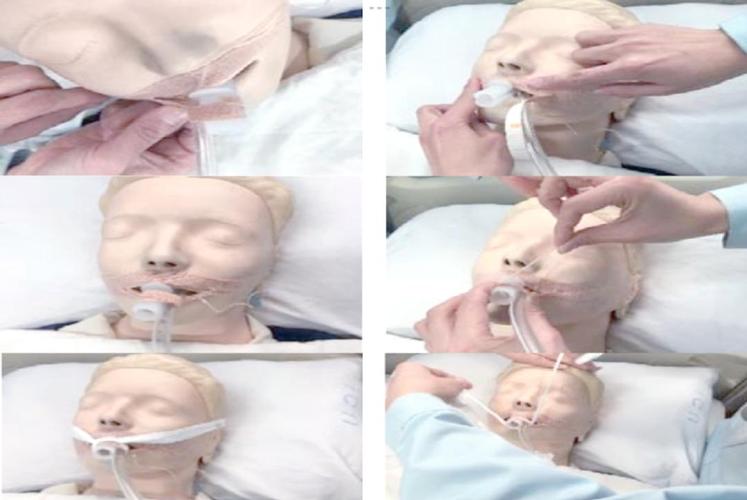 新生儿气管插管固定如何避免移位与皮肤损伤?-第1张图片-郑州医学网 新生儿气管插管固定如何避免移位与皮肤损伤?-第1张图片-郑州医学网