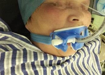 新生儿气管插管固定如何避免移位与皮肤损伤?-第2张图片-郑州医学网 新生儿气管插管固定如何避免移位与皮肤损伤?-第2张图片-郑州医学网