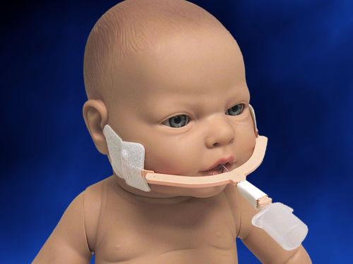 新生儿气管插管固定如何避免移位与皮肤损伤?-第3张图片-郑州医学网 新生儿气管插管固定如何避免移位与皮肤损伤?-第3张图片-郑州医学网