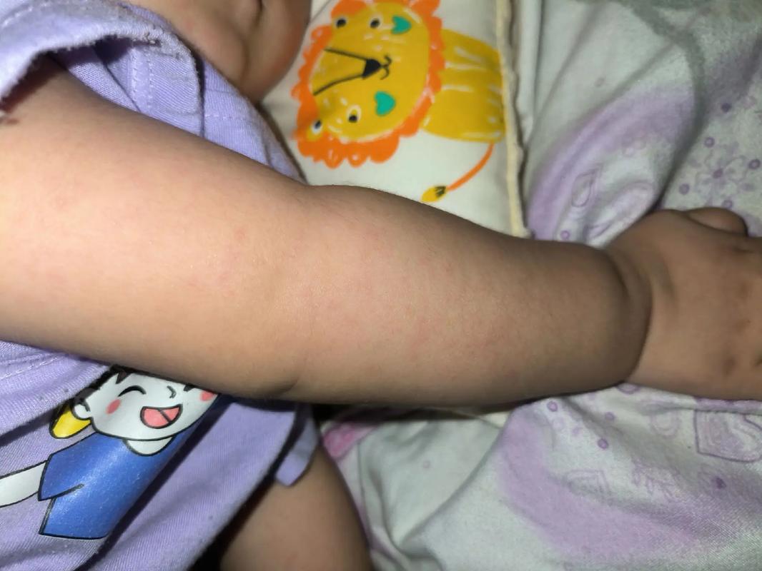 新生儿宝宝身上出现红点点是正常现象还是需要警惕的皮肤问题?-第2张图片-郑州医学网 新生儿宝宝身上出现红点点是正常现象还是需要警惕的皮肤问题?-第2张图片-郑州医学网