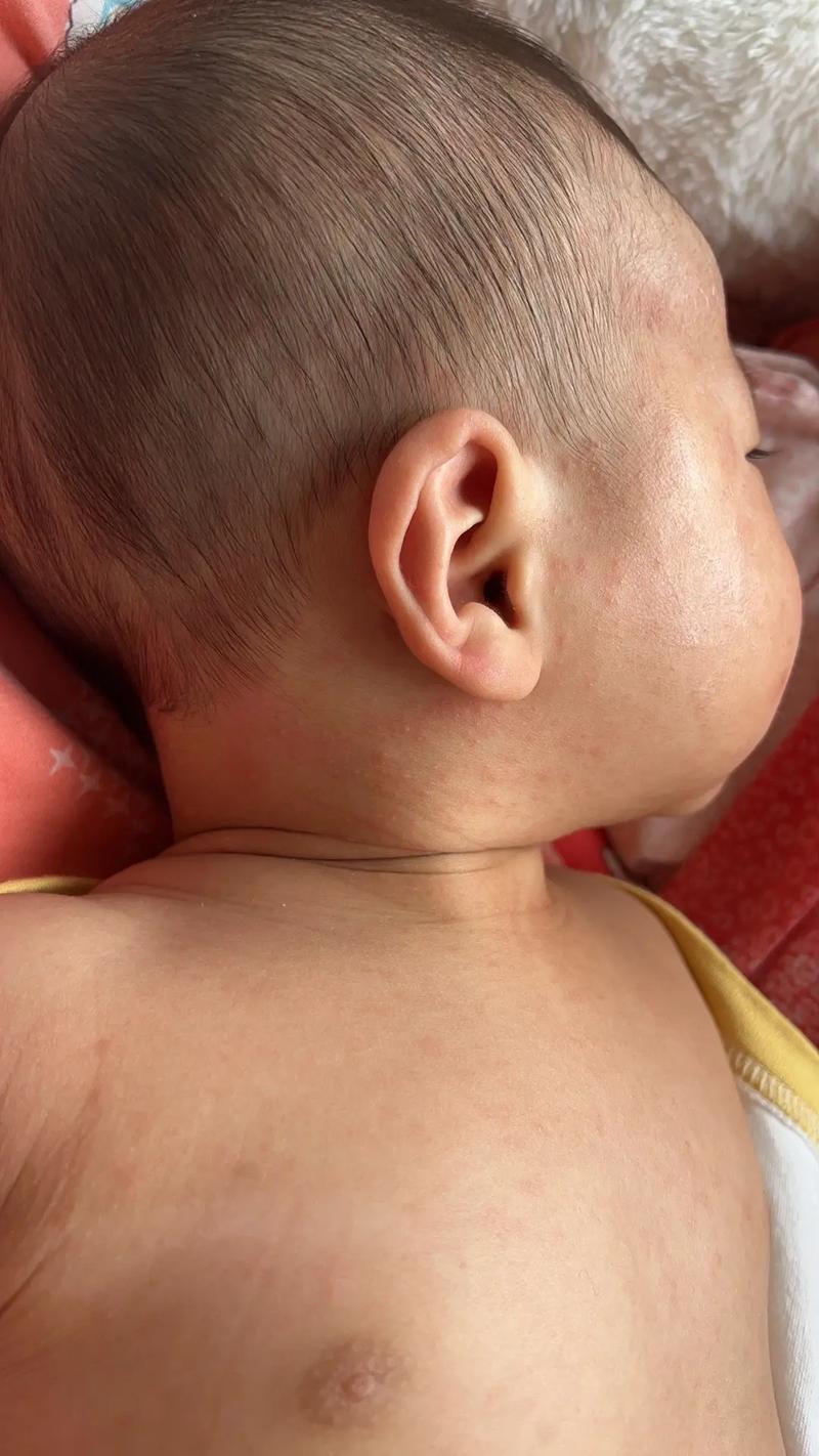 新生儿宝宝身上出现红点点是正常现象还是需要警惕的皮肤问题?-第1张图片-郑州医学网 新生儿宝宝身上出现红点点是正常现象还是需要警惕的皮肤问题?-第1张图片-郑州医学网