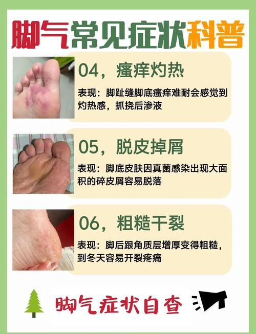 儿童脚气反复难除根？日常护理+科学用药如何双管齐下根治？-第1张图片-郑州医学网