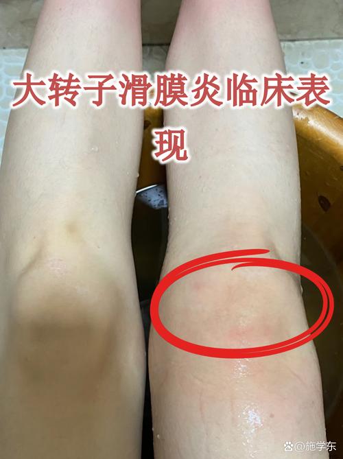 儿童髋关节滑膜炎有哪些典型症状?家长如何早期识别与应对?-第3张图片-郑州医学网 儿童髋关节滑膜炎有哪些典型症状?家长如何早期识别与应对?-第3张图片-郑州医学网