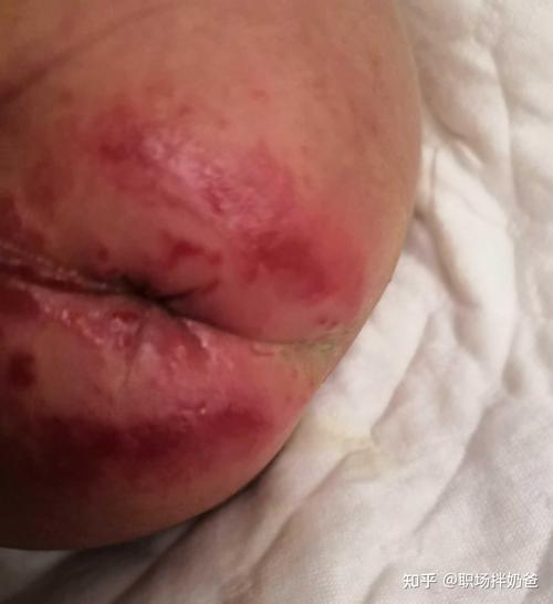 新生儿拉肚子屁股溃烂,该如何护理才能避免加重?-第1张图片-郑州医学网 新生儿拉肚子屁股溃烂,该如何护理才能避免加重?-第1张图片-郑州医学网