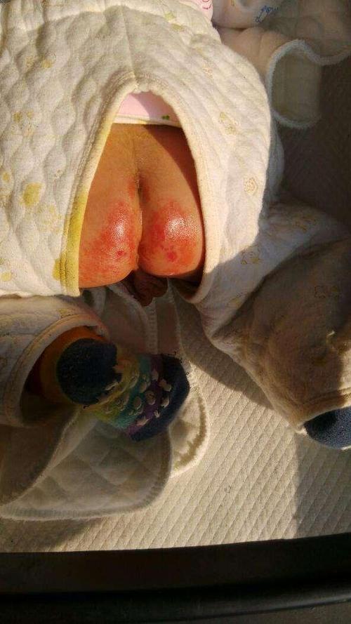 新生儿拉肚子屁股溃烂，该如何护理才能避免加重？-第2张图片-郑州医学网