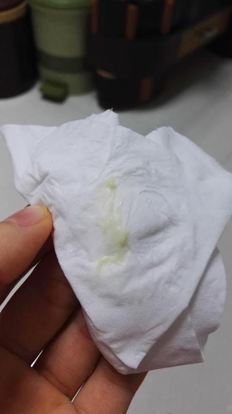 孕期白带像黄鼻涕一样，是正常现象还是感染信号？需要警惕哪些问题？-第2张图片-郑州医学网