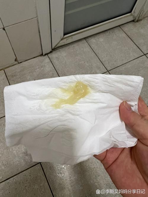 孕期白带像黄鼻涕一样，是正常现象还是感染信号？需要警惕哪些问题？-第1张图片-郑州医学网