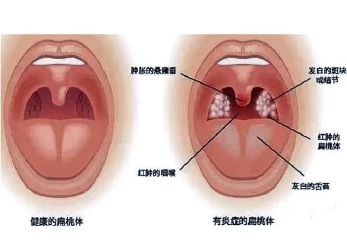 儿童扁桃体大小图怎么看？不同年龄段正常范围是多少？-第3张图片-郑州医学网