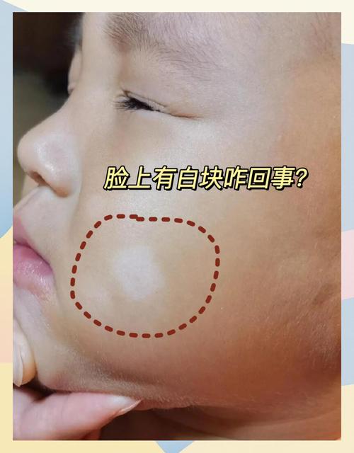 儿童脸上出现白斑是白癜风还是其他皮肤病?家长该如何科学应对?-第1张图片-郑州医学网 儿童脸上出现白斑是白癜风还是其他皮肤病?家长该如何科学应对?-第1张图片-郑州医学网