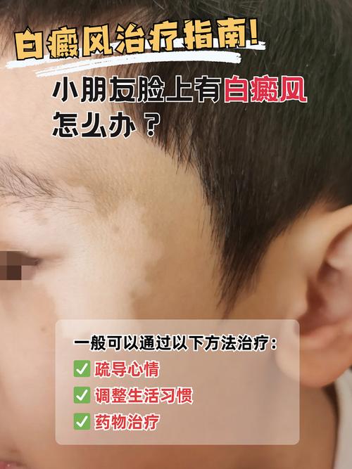 儿童脸上出现白斑是白癜风还是其他皮肤病?家长该如何科学应对?-第3张图片-郑州医学网 儿童脸上出现白斑是白癜风还是其他皮肤病?家长该如何科学应对?-第3张图片-郑州医学网