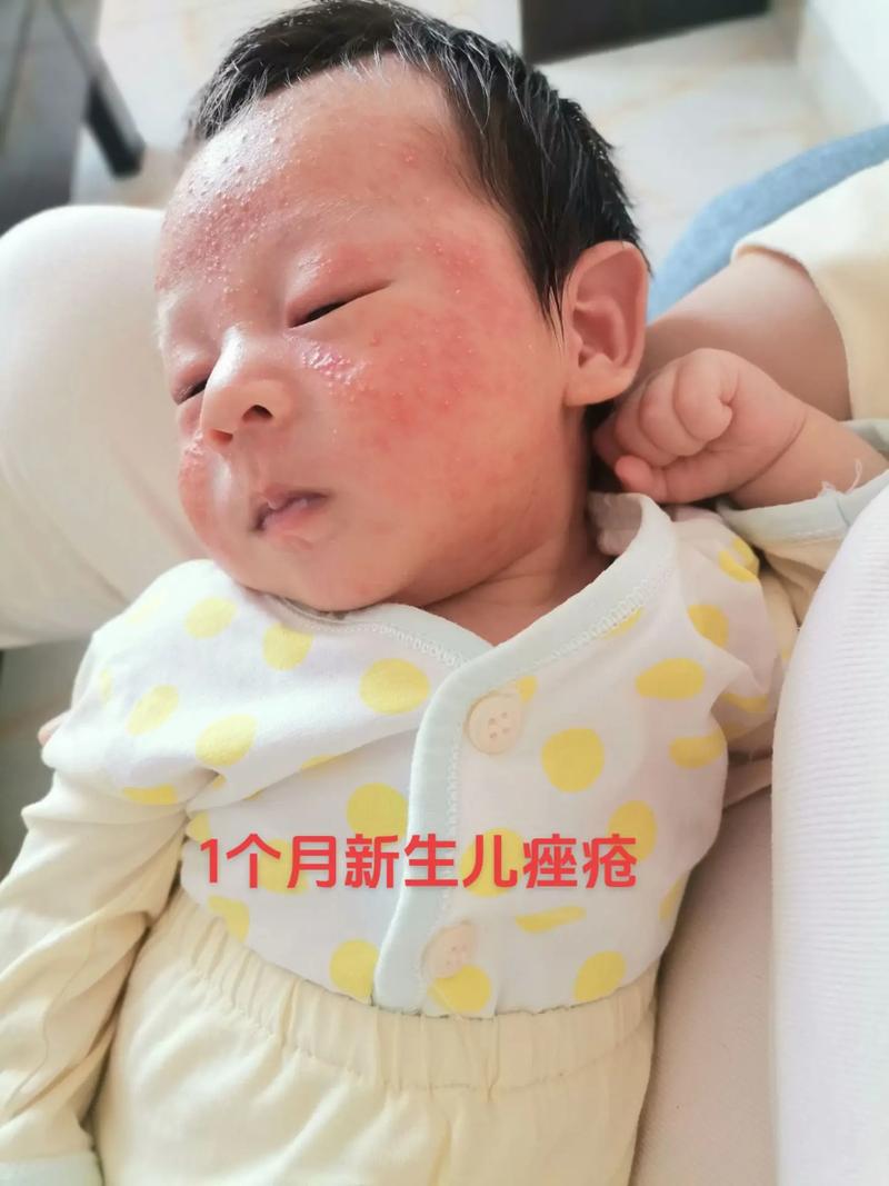 新生儿痤疮和婴儿痤疮是一回事吗?该如何区分护理?-第2张图片-郑州医学网 新生儿痤疮和婴儿痤疮是一回事吗?该如何区分护理?-第2张图片-郑州医学网