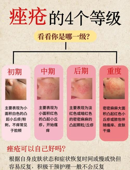 新生儿痤疮和婴儿痤疮是一回事吗?该如何区分护理?-第1张图片-郑州医学网 新生儿痤疮和婴儿痤疮是一回事吗?该如何区分护理?-第1张图片-郑州医学网