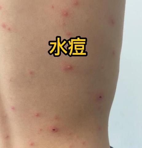 儿童长水痘期间饮食禁忌有哪些？这些食物吃了会加重病情吗？-第3张图片-郑州医学网