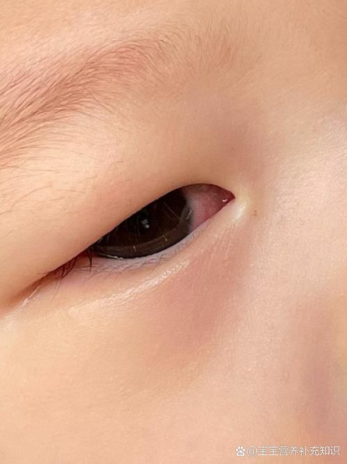 新生儿眼角出现小红疙瘩是什么原因？需要担心吗？-第2张图片-郑州医学网