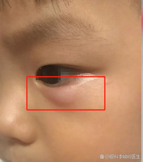 新生儿眼角出现小红疙瘩是什么原因？需要担心吗？-第3张图片-郑州医学网