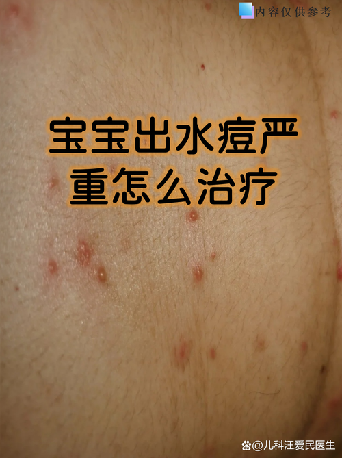 儿童出水痘时饮食禁忌有哪些?这些食物吃了会加重病情吗?-第2张图片-郑州医学网 儿童出水痘时饮食禁忌有哪些?这些食物吃了会加重病情吗?-第2张图片-郑州医学网