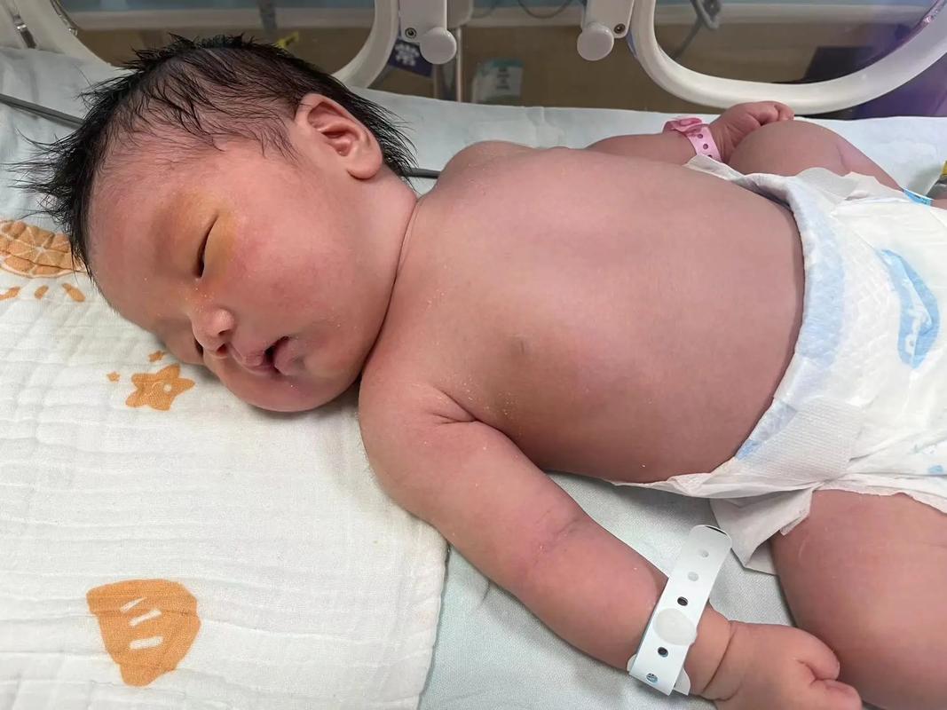 北京儿研所新生儿黄疸怎么处理？需要蓝光治疗吗？-第1张图片-郑州医学网