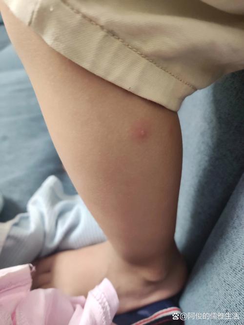 儿童出水痘初期症状有哪些典型表现?家长该如何及时识别与应对?-第1张图片-郑州医学网 儿童出水痘初期症状有哪些典型表现?家长该如何及时识别与应对?-第1张图片-郑州医学网