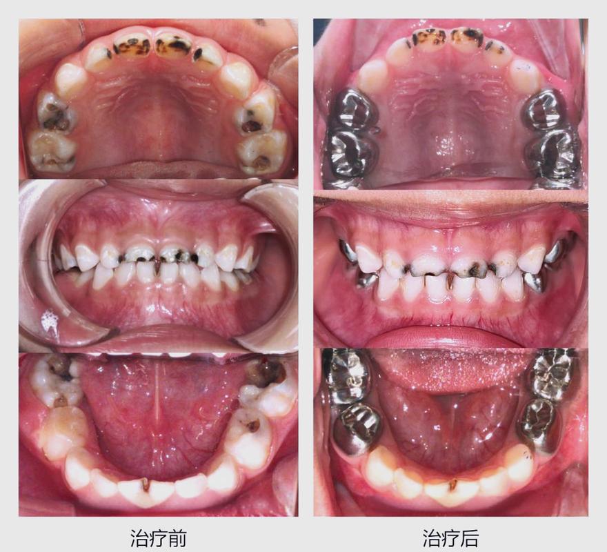 儿童全麻拔牙安全吗？风险与家长最该关注的注意事项有哪些？-第3张图片-郑州医学网