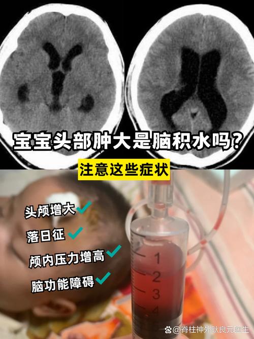 儿童急性脑炎能否治愈？后遗症风险与治疗关键点解析-第3张图片-郑州医学网