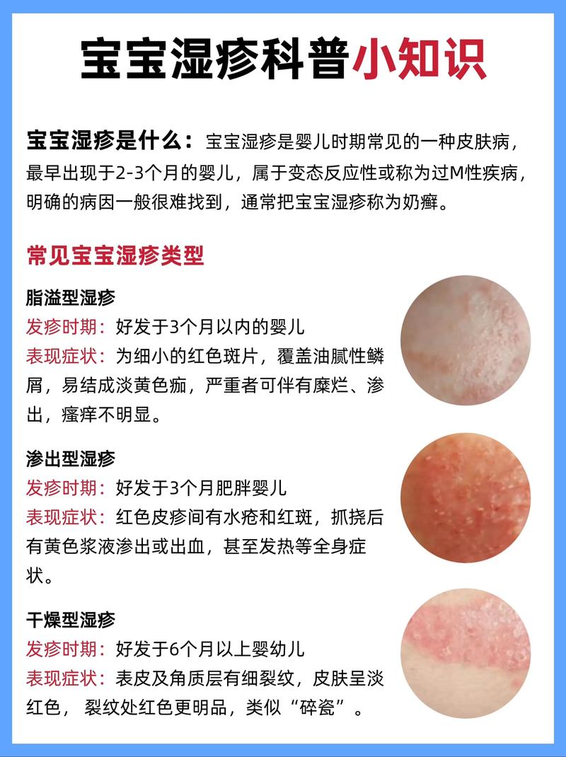 儿童皮炎湿疹反复发作，到底该如何科学治疗才能根治？-第1张图片-郑州医学网