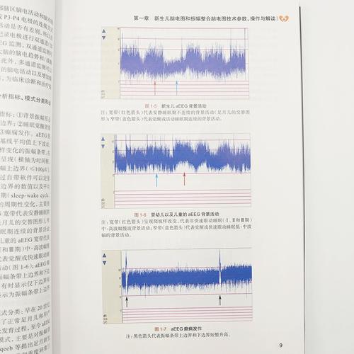 新生儿振幅整合脑电图如何精准评估脑功能发育异常?-第3张图片-郑州医学网 新生儿振幅整合脑电图如何精准评估脑功能发育异常?-第3张图片-郑州医学网