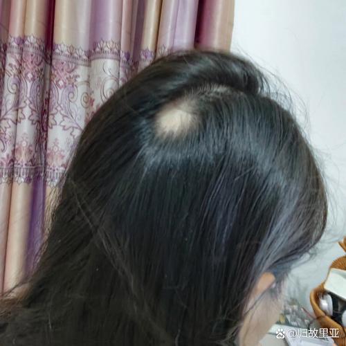 孕期为何会突然出现斑秃?是激素波动还是营养失衡在作祟?-第1张图片-郑州医学网 孕期为何会突然出现斑秃?是激素波动还是营养失衡在作祟?-第1张图片-郑州医学网