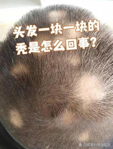 孕期为何会突然出现斑秃?是激素波动还是营养失衡在作祟?-第2张图片-郑州医学网 孕期为何会突然出现斑秃?是激素波动还是营养失衡在作祟?-第2张图片-郑州医学网