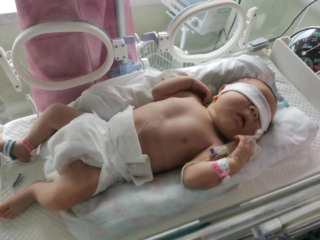 新生儿直接胆红素86μmol/L需要立即干预吗？-第2张图片-郑州医学网