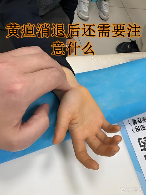 新生儿直接胆红素86μmol/L需要立即干预吗？-第3张图片-郑州医学网