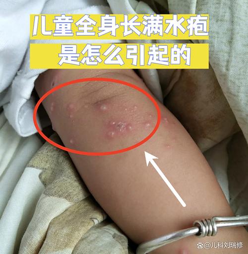 儿童水痘初期症状有哪些？不同阶段水痘图片如何区分严重程度？-第2张图片-郑州医学网