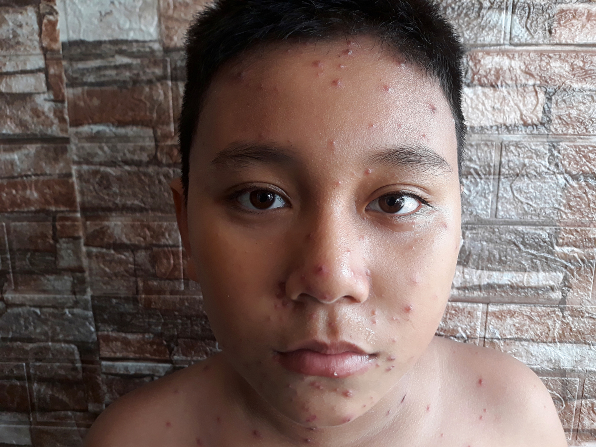 儿童水痘初期症状有哪些？不同阶段水痘图片如何区分严重程度？-第3张图片-郑州医学网