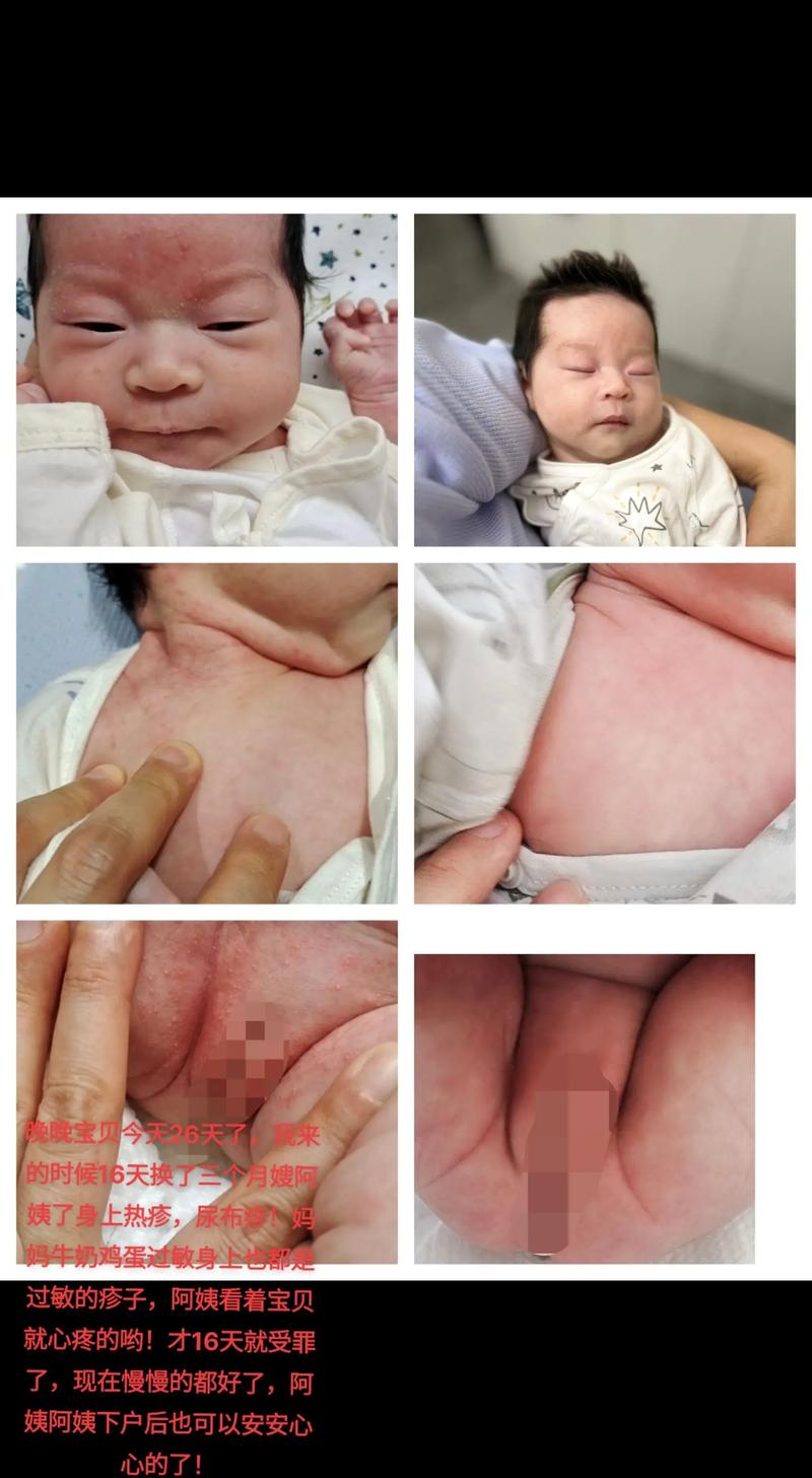 新生儿GBS宫内感染的高危因素有哪些？如何早期识别与干预？-第2张图片-郑州医学网