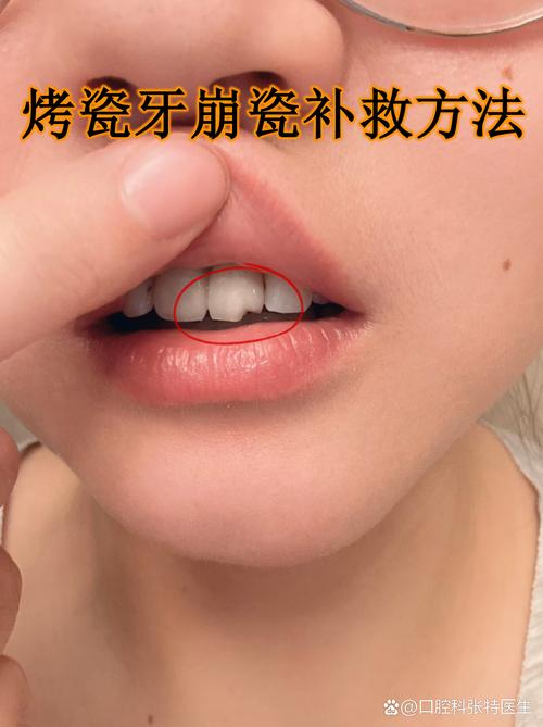 孕期烤瓷牙松动，会不会影响胎儿健康？该如何安全处理？-第1张图片-郑州医学网