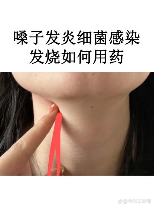 孕期扁桃体发炎青霉素-第1张图片-郑州医学网