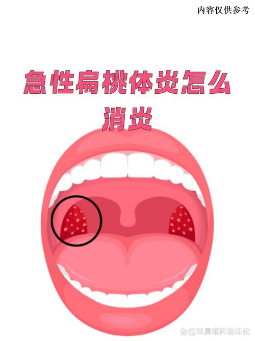 孕期扁桃体发炎青霉素-第2张图片-郑州医学网
