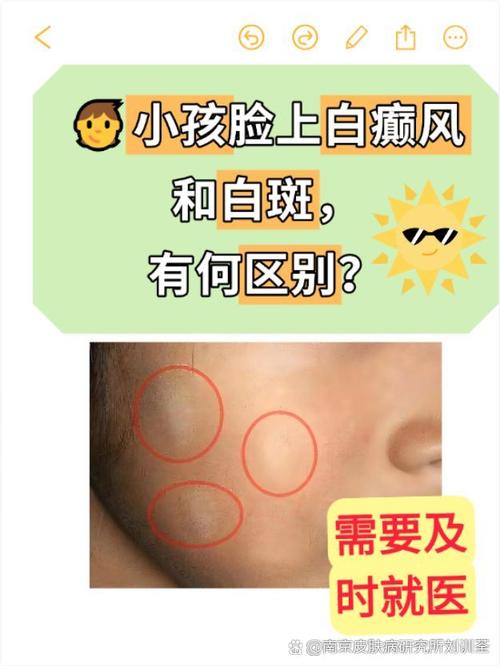 儿童脸上出现白斑，真的是缺锌引起的吗？还有哪些可能原因？-第1张图片-郑州医学网