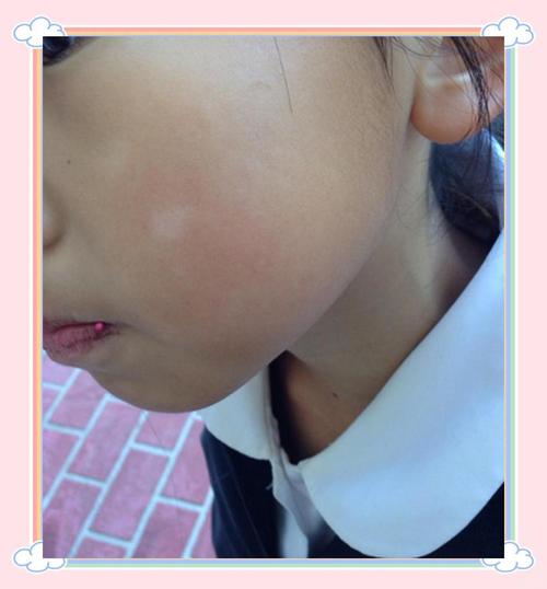 儿童脸上出现白斑，真的是缺锌引起的吗？还有哪些可能原因？-第2张图片-郑州医学网