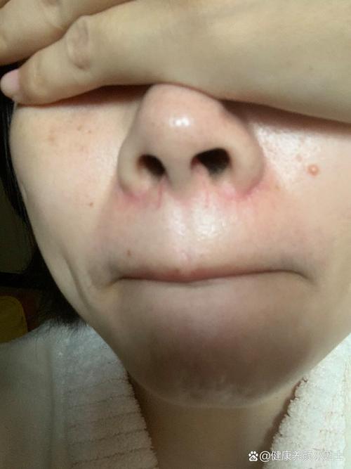 孕期鼻子里一直有血丝-第1张图片-郑州医学网