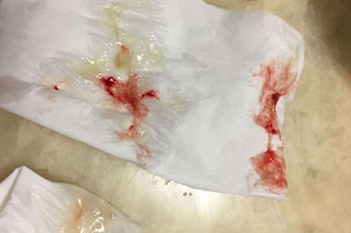 孕期鼻子里一直有血丝-第2张图片-郑州医学网