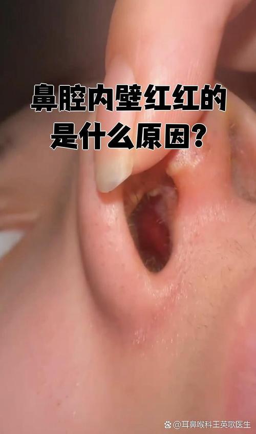 孕期鼻子里一直有血丝-第3张图片-郑州医学网