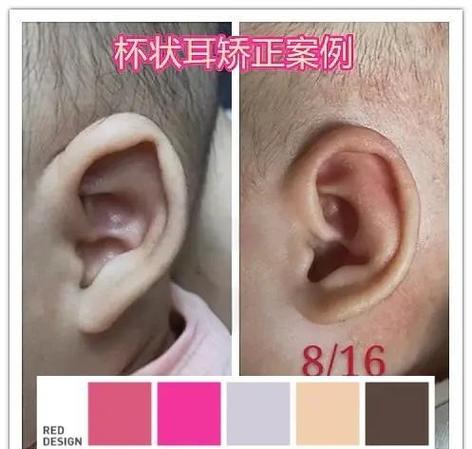 新生儿两只耳朵大小不一,是正常生理差异还是需要干预的异常情况?-第2张图片-郑州医学网 新生儿两只耳朵大小不一,是正常生理差异还是需要干预的异常情况?-第2张图片-郑州医学网