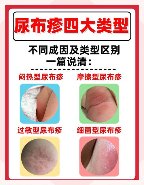 新生儿尿里有点红是上火还是疾病信号？需要担心吗？-第3张图片-郑州医学网