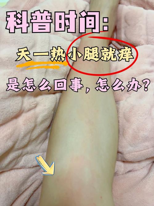 孕期小腿痒别大意！是皮肤干燥还是妊娠期肝内胆汁淤积症作祟？-第1张图片-郑州医学网