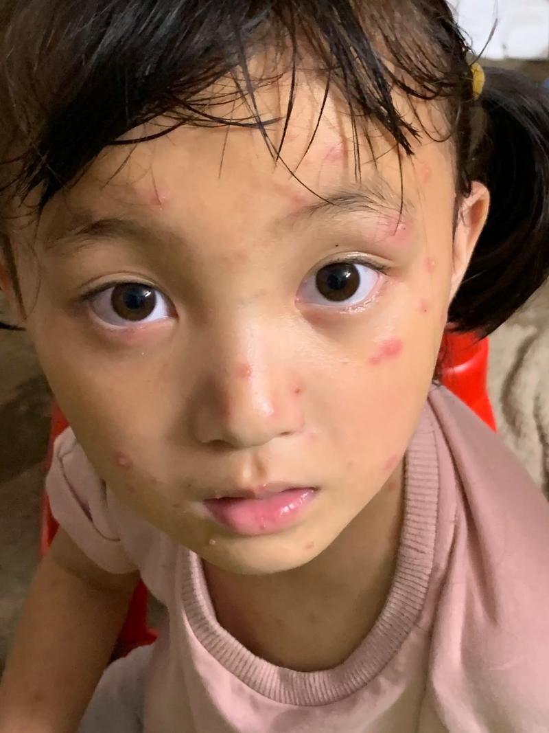 儿童水痘第几天最严重？症状高峰期如何护理？-第1张图片-郑州医学网