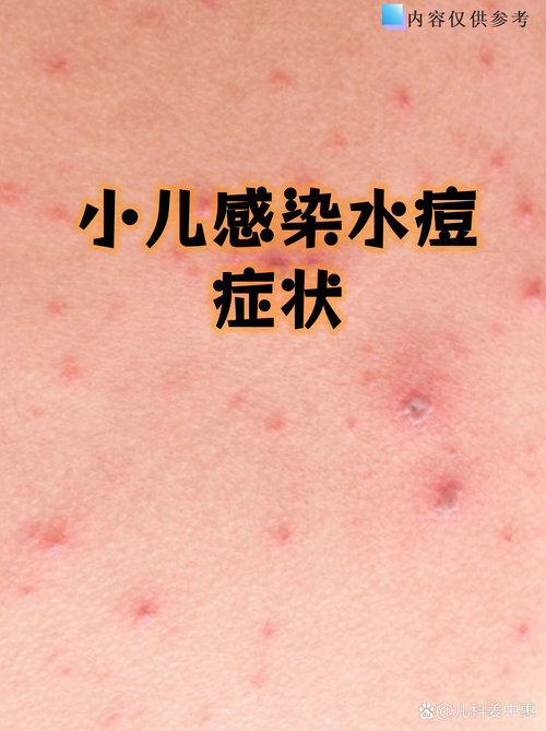 儿童水痘第几天最严重？症状高峰期如何护理？-第2张图片-郑州医学网
