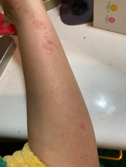 儿童线状苔藓能彻底治好吗？有没有有效的治疗方法能防止复发？-第2张图片-郑州医学网