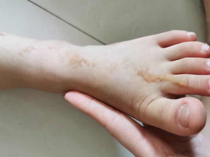 儿童线状苔藓能彻底治好吗？有没有有效的治疗方法能防止复发？-第3张图片-郑州医学网