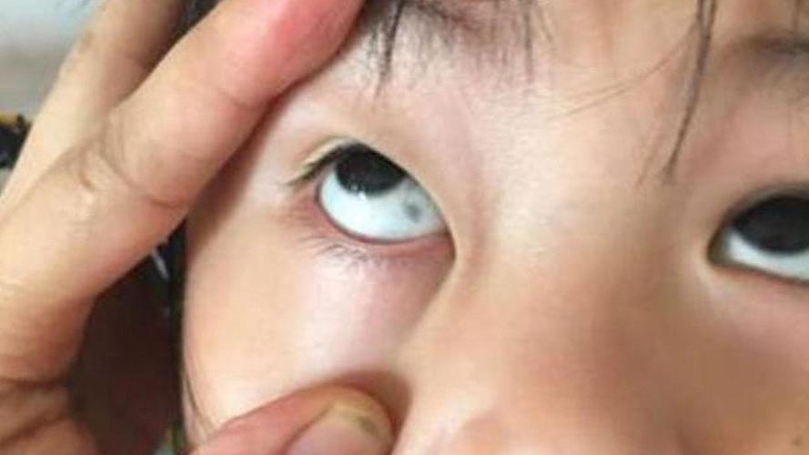 儿童眼睛里的黑斑是先天性的吗？需要警惕哪些眼部疾病？-第1张图片-郑州医学网